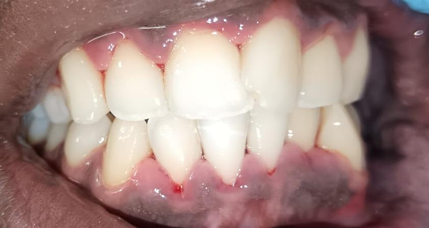 After teeth cleaning