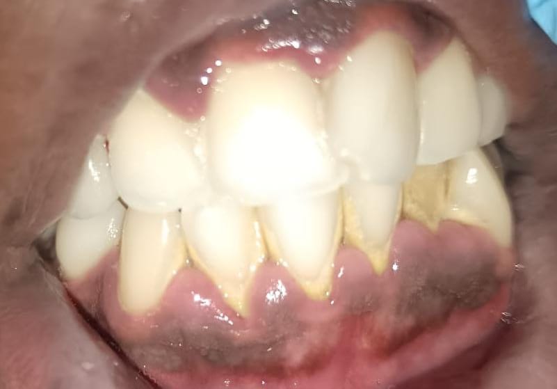 Before teeth cleaning