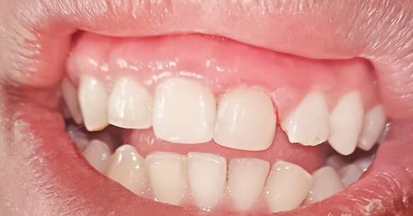 After dental restoration
