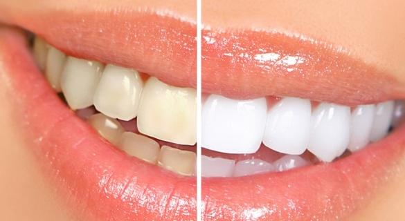 Teeth Whitening